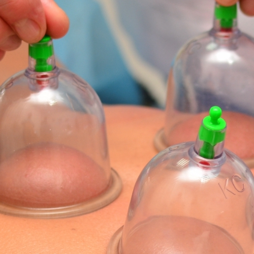 Cupping-Maximum-Rehabilitation-Services-Chicago-Evergreen-Park-Munster-IL