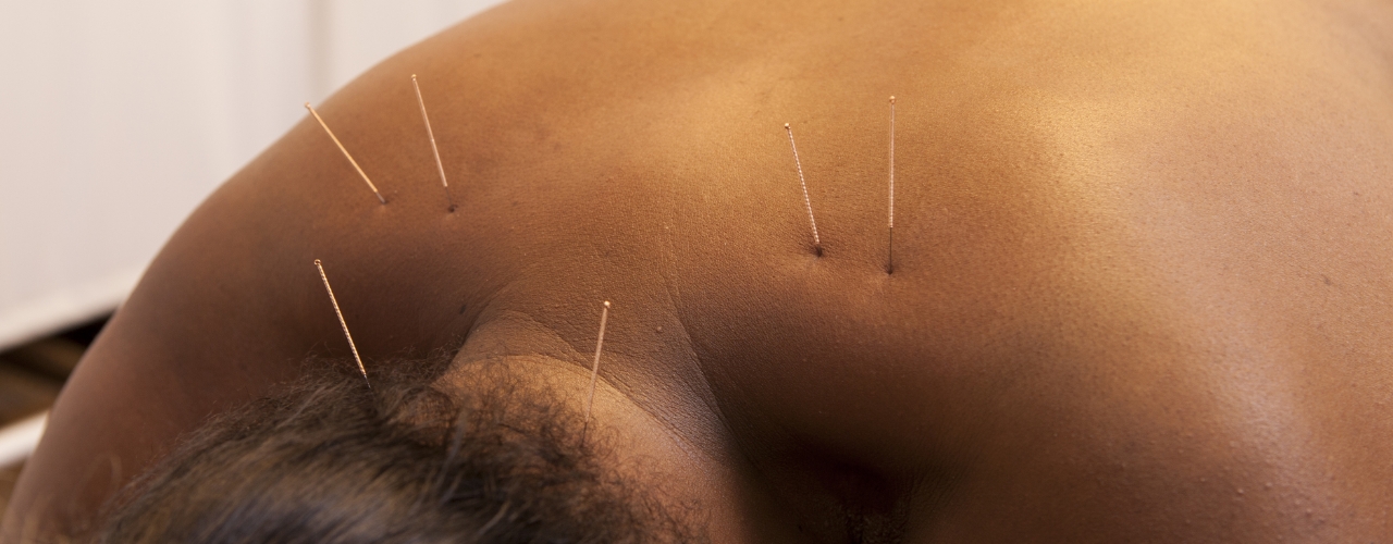 Dry-Needling-Maximum-Rehabilitation-Services-Chicago-Evergreen-Park-Munster-IL