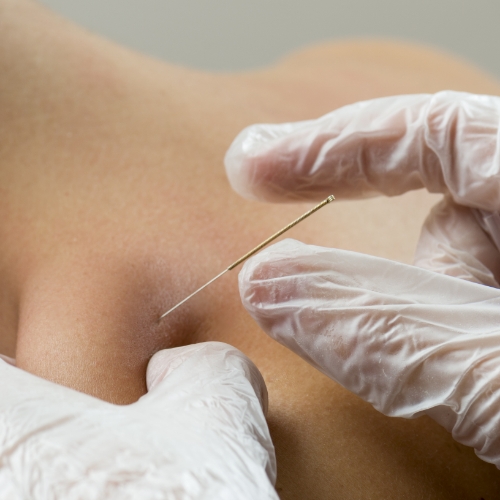 Dry-Needling-Maximum-Rehabilitation-Services-Chicago-Evergreen-Park-Munster-IL